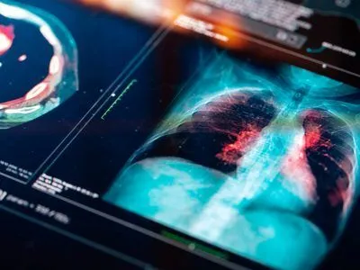 tobacco lung cancer attorney/lawyer Dallas Lung Cancer Lawyers
