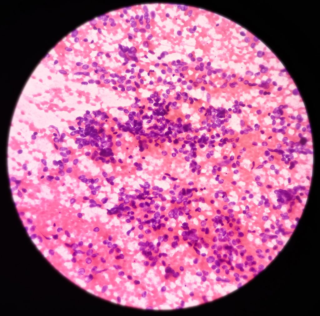 Lung cancer, photomicrograph of small cell carcinoma, malignant cells, sample sapirate from lung mass by CT guided FNA