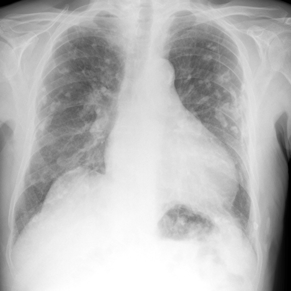 Pleural plaques as an indicator of asbestos exposure