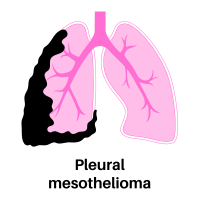 Pleural Mesothelioma graphic