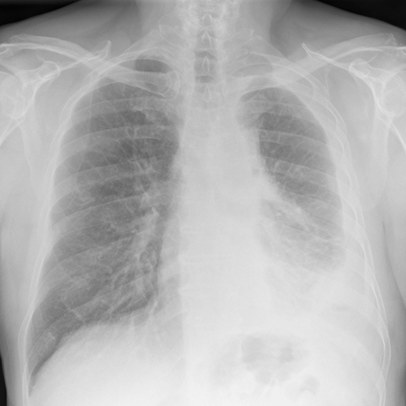 x-ray of of mesothelioma forming in chest and abdomen due to asbestos exposure