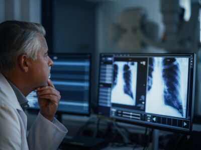 physician examining low-dose CT scan results for early lung cancer detection