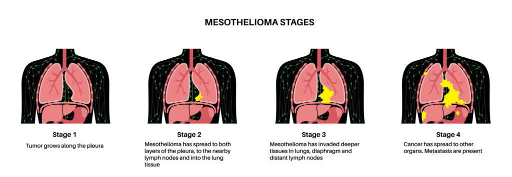 Infographic showing mesothelioma stages from stage 1 to stage 4 with symptoms