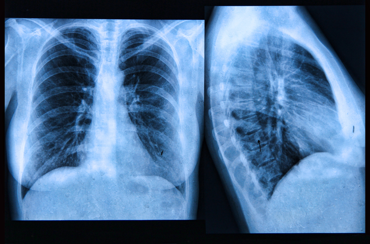 Chest X-rays showing potential signs of lung cancer, used to highlight diagnostic challenges in Africa