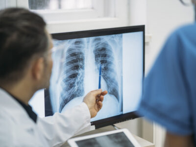 Doctor reviewing chest X-ray to diagnose pleural mesothelioma after asbestos exposure