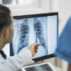 Doctor reviewing chest X-ray to diagnose pleural mesothelioma after asbestos exposure