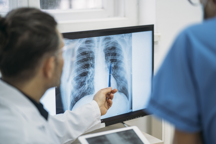 Doctor reviewing chest X-ray to diagnose pleural mesothelioma after asbestos exposure